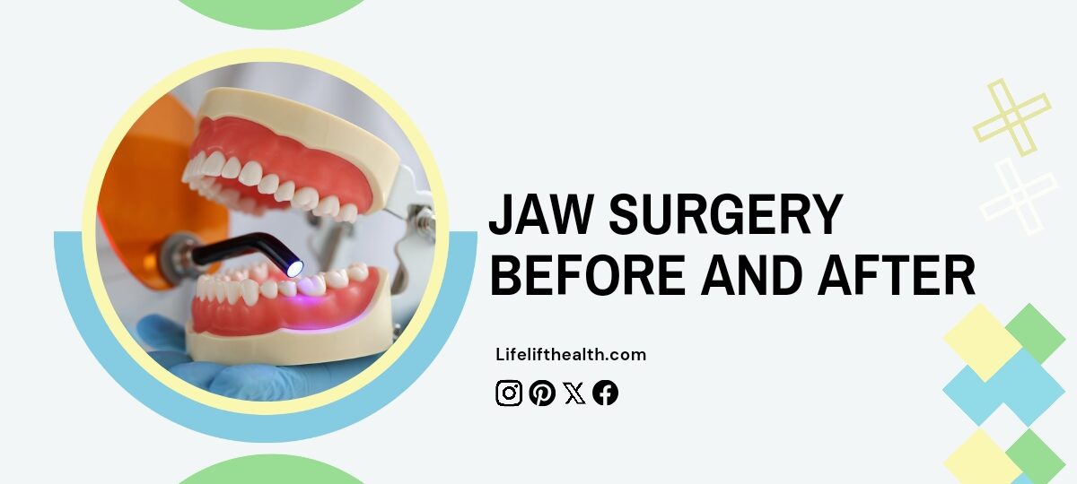 jaw surgery before and after