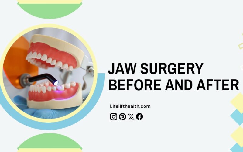 Jaw surgery before and after