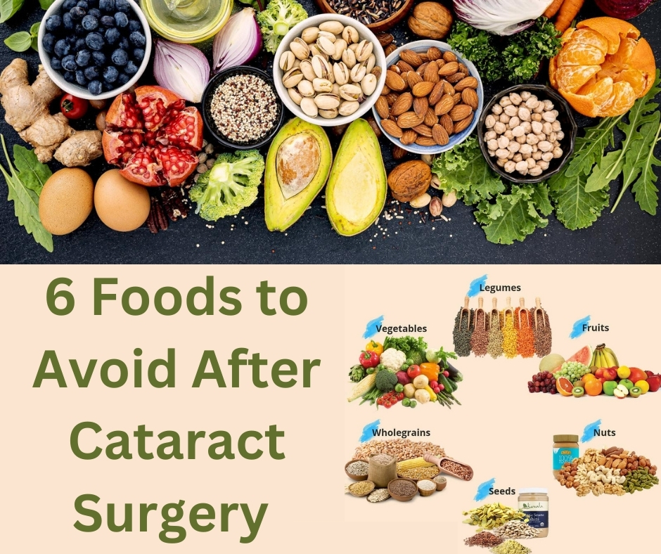 6 Foods to Avoid After Cataract Surgery for a Speedy Recovery